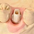 Art.lab Dentallabor Implantatversorgung Vollkeramik