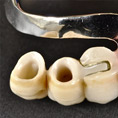 Art.lab Dentallabor herausnehmbarer Zahnersatz