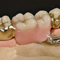 Art.lab Dentallabor herausnehmbarer Zahnersatz